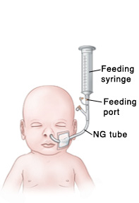 Outline of baby's head and chest showing NG tube in nose connected to feeding port and feeding syringe.