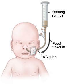 Outline of baby's head and chest showing NG tube in nose connected to feeding port and feeding syringe. Liquid food in feeding syringe flows into baby through NG tube.