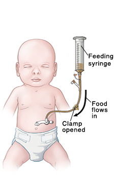 Outline of baby with tube inserted in stomach. Feeding port is near skin, and clamp is open on extension tubing. Feeding syringe is inserted into extension tubing. Liquid food flows into baby's stomach.