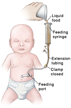 Outline of baby with tube inserted in stomach. Feeding port is near skin, and clamp is closed on extension tubing. Feeding syringe is inserted into extension tubing. Hand is pouring liquid food into feeding syringe.