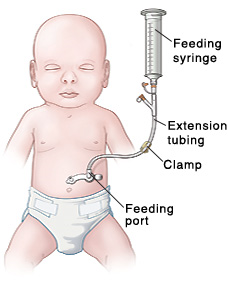 Gastrostomy Or Gastro Jejunum Tube Syringe Feeding