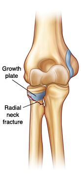 Front view of elbow joint showing growth plate on radius. Radial neck fracture goes through growth plate and bone.
