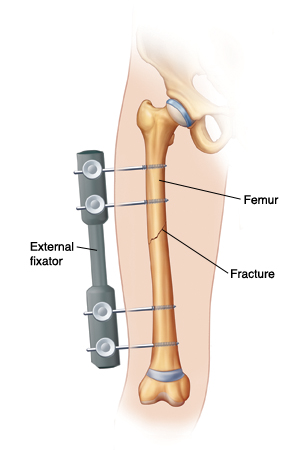 Outline of leg showing screws going through skin into femur. Screws are connected to external fixator on outside of leg. External fixator is holding fracture together.