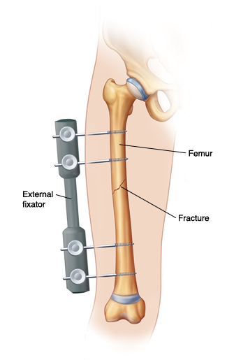 Outline of leg showing screws going through skin into femur. Screws are connected to external fixator on outside of leg. External fixator is holding fracture together.
