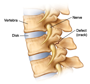 Side view of vertebrae with spondylolysis showing defect (crack) at back of one vertebra, the nerve and disk.