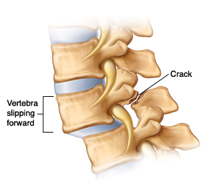 Side view of vertebrae with spondylolisthesis  showing vertebra slipping forward and causing crack at back of one vertebra.