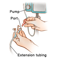 Closeup of hands disconnecting feeding bag tubing from port on extension tubing. Feeding bag tubing is connected to pump.