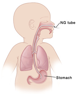 Outline of baby with head turned to side showing NG tube in nose, down back of throat, into esophagus, and ending in stomach. Mark on NG tube is at nose.