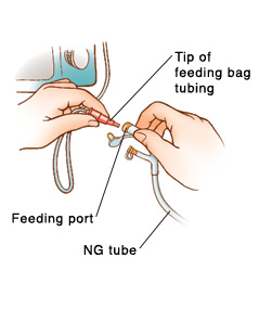 Closeup of hands connecting feeding bag tubing to port on NG tube. Feeding bag tubing is connected to pump.