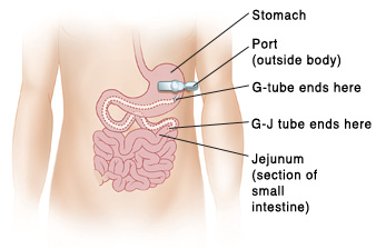 Gastrostomy Or Gastro Jejunum Tube Syringe Feeding