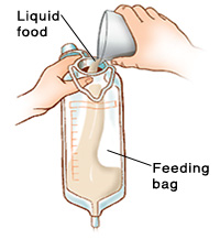 Closeup of hands pouring liquid food into feeding bag.