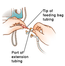 Closeup of hands connecting feeding bag tubing with port on extension tubing. Feeding bag tubing is connected to pump.