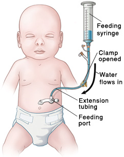 Outline of baby with tube inserted in stomach. Feeding port is near skin, and clamp is open on extension tubing. Feeding syringe is inserted into extension tubing. Water flows into baby's stomach.