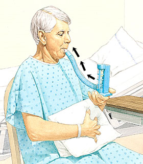 Man in hospital gown sitting with pillow held to abdomen. Other hand is holding incentive spirometer. Spirometer mouthpiece is in man's mouth, arrows show him breathing in.