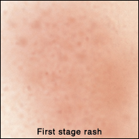 Closeup of skin showing first stage rash. Rash is in large patch.