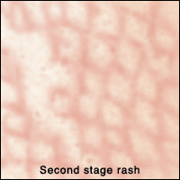 Closeup of skin showing second stage rash. Rash looks lacy.