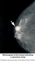 Picture of mammogram of the breast indicating a cancerous lump
