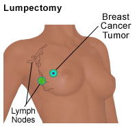 Illustration of a lumpectomy