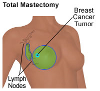 Illustration of a total mastectomy