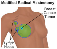 Illustration of a modified radical mastectomy