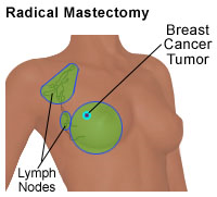 Illustration of a radical mastectomy