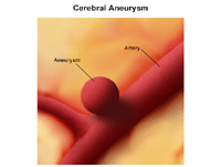 Illustration of an intracranial aneurysm