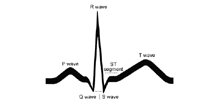 Illustration of a basic EKG tracing