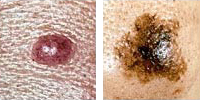 Photo comparing normal and melanoma moles showing asymmetry
