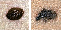 Photo comparing normal and melanoma moles showing border irregularity