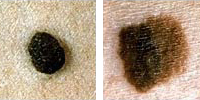 Photo comparing normal and melanoma moles showing color