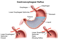 Illustration demonstrating gastroesophageal reflux
