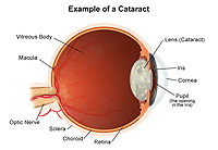 Illustration of a cataract