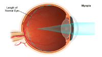 Illustration demonstrating  myopia
