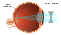 Illustration demonstrating myopia corrected