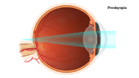 Illustration demonstrating presbyopia