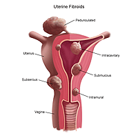 Illustration of uterine fibroids