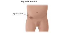 Illustration of an inguinal hernia