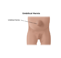 Illustration of an umbilical hernia