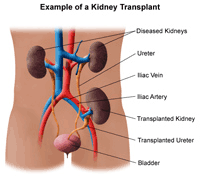 Example of Kidney Transplant