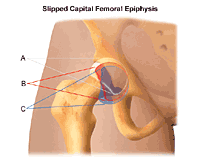 Illustration demonstrating slipped capital femoral epiphysis