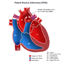Illustration of the anatomy of a heart with a patent ductus arteriosus
