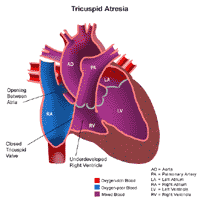 Anatomy of a heart with tricuspid atresia