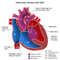 Pulmonary Atresia (PA)