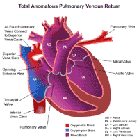 Anatomy of a heart with total anomalous pulmonary venous return