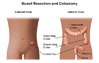 Illustration of bowel resection and colostomy