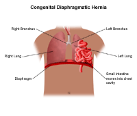 Illustration of congenital diaphragmatic hernia