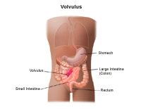 Illustration demonstrating a volvulus