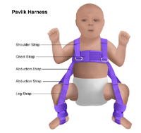 Illustration of infant wearing a Pavlik harness