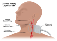 Illustration of a carotid artery duplex scan