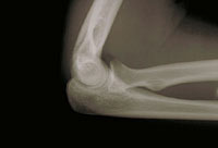 A picture of an X-ray of the elbow